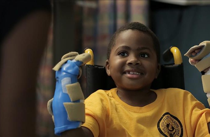 Zion Harvey, el primer niño del mundo en recibir un trasplante de manos